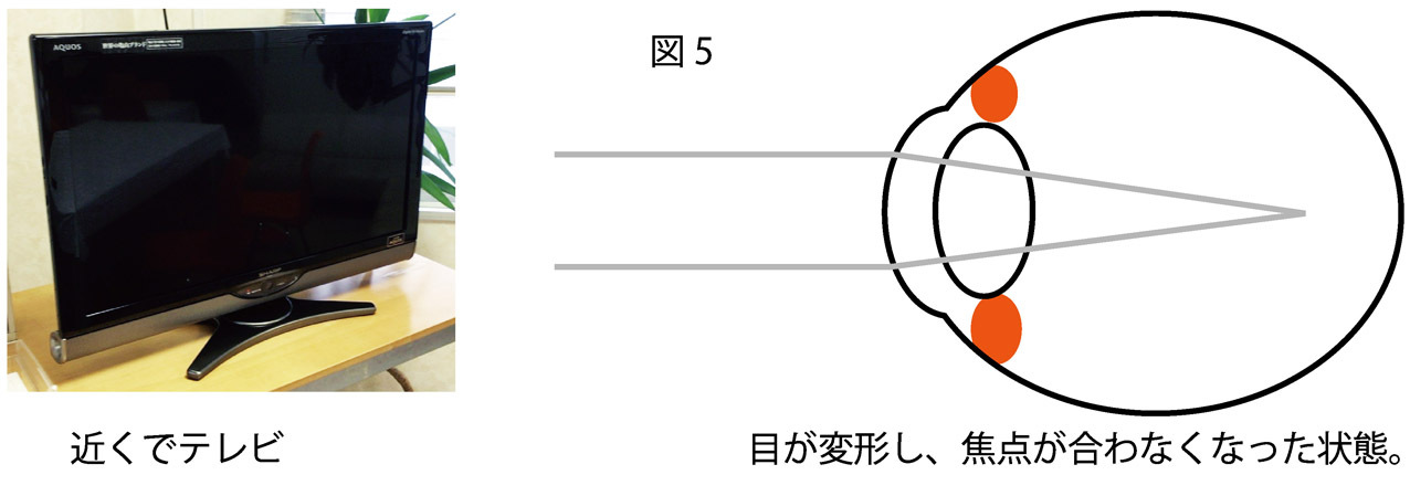 近視のメカニズム5