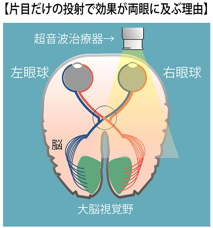 視神経は内部で交叉しているので片目に投射すると、両眼に効果が及びます。